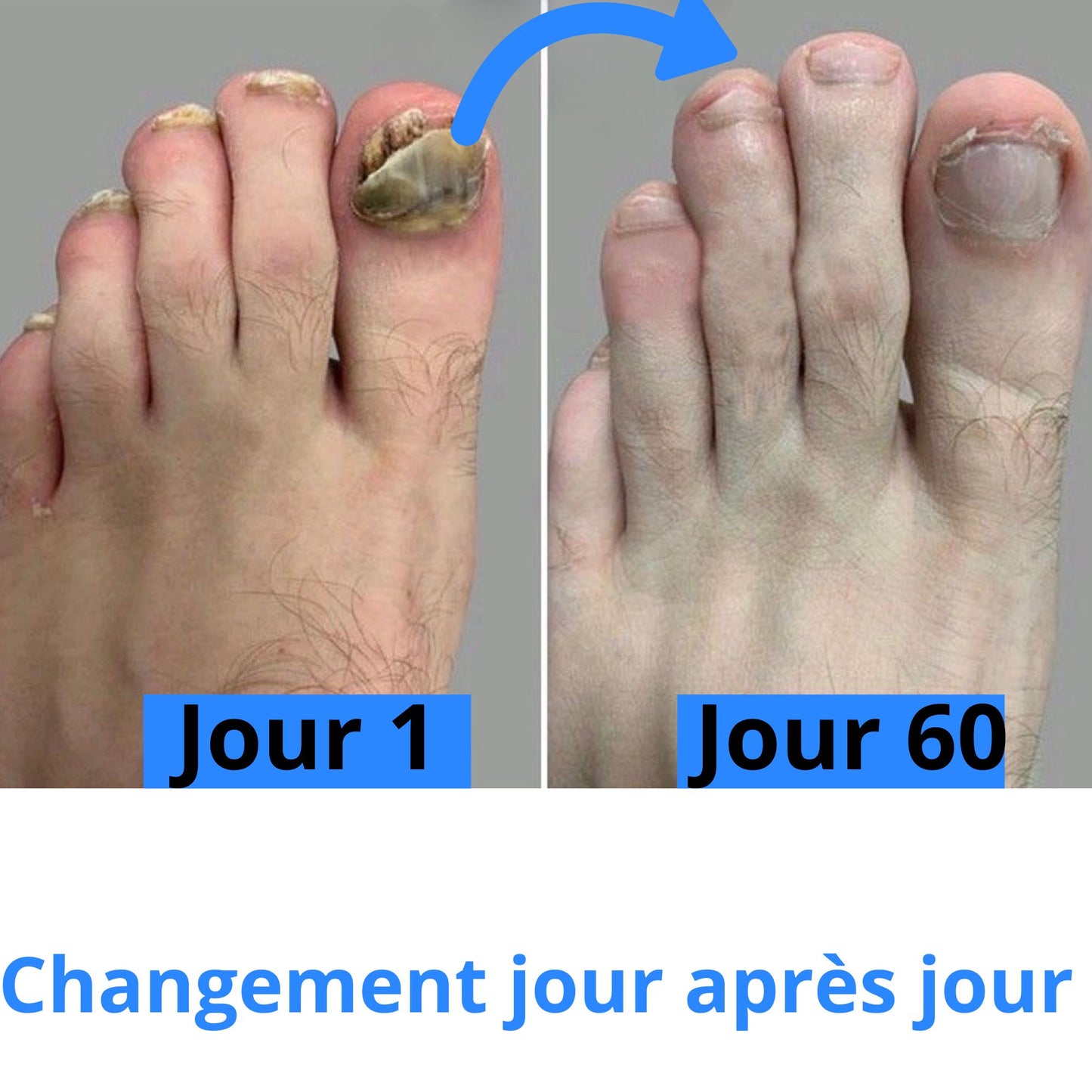 Appareil Anti-Mycose Révolutionnaire