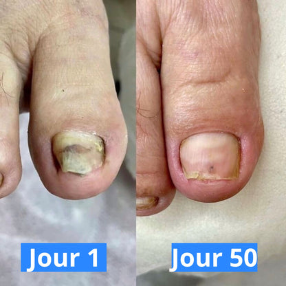 Appareil Anti-Mycose Révolutionnaire