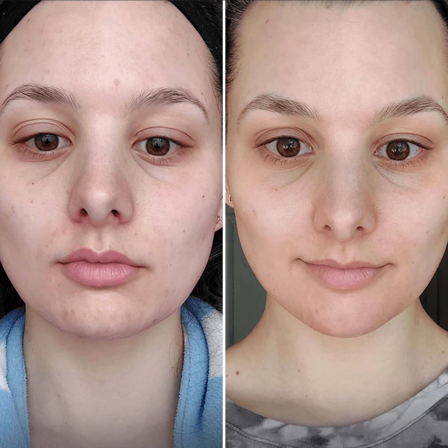 Rouleau à glaçon visage