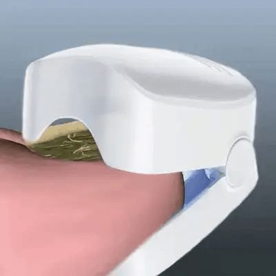 Appareil Anti-Mycose Révolutionnaire